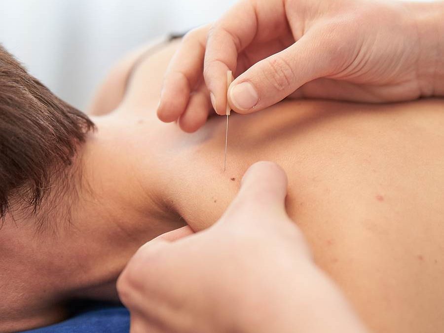 What is DRY NEEDLING?